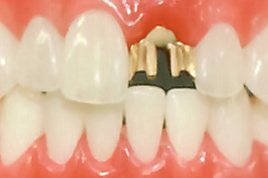歯を守るための 削らないブリッジ